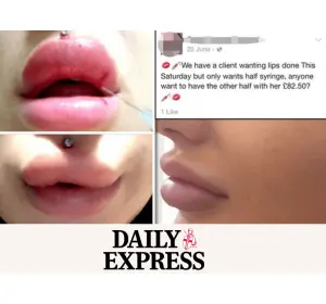 Save Face in the Express: REVEALED: Lip filler frenzy leaving teenage girls with HORRIFIC damage