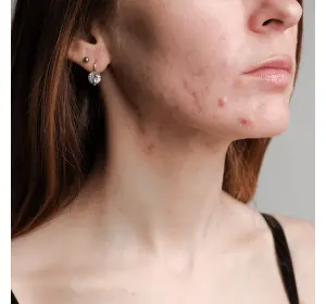 How to Deal with Acne as an Adult