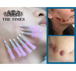 The Times: Unregulated facial ‘thread lifts’ put women in A&E